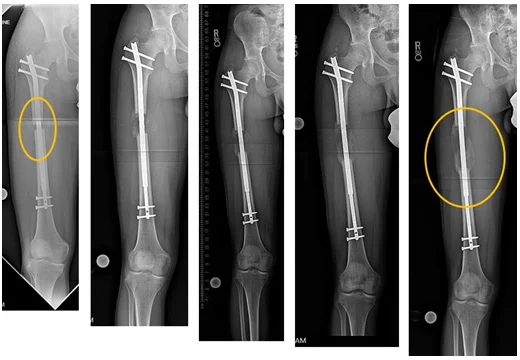 No pain no gain – the cost of centimetres 